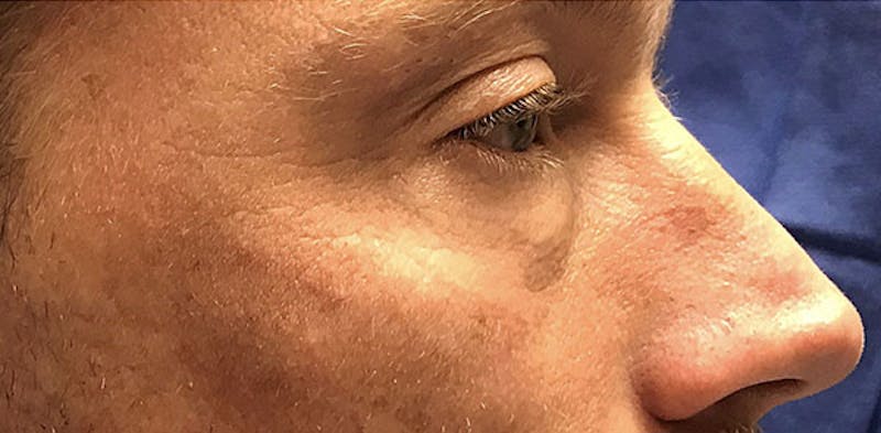 Lower Blepharoplasty Before & After Gallery - Patient 775466 - Image 5