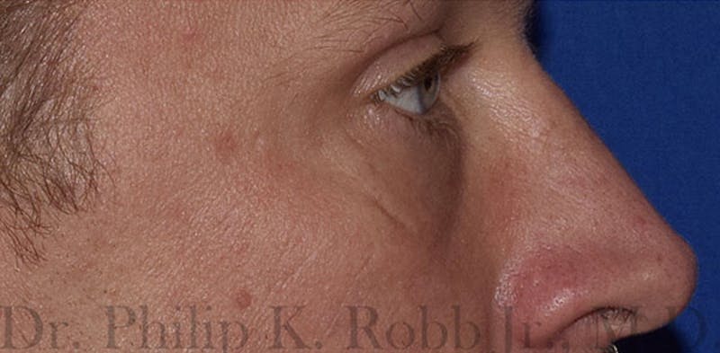 Lower Blepharoplasty Before & After Gallery - Patient 775466 - Image 6