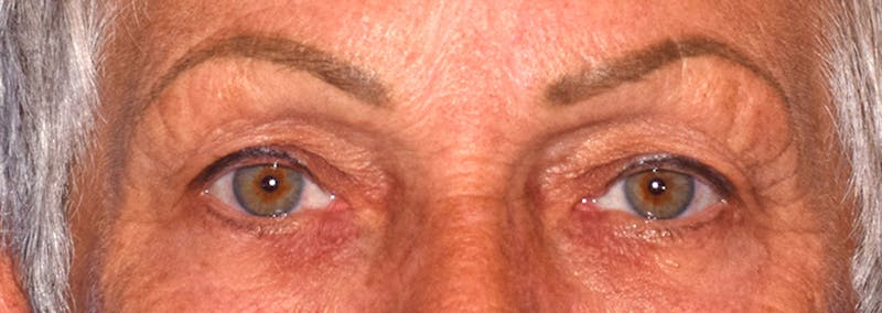 Upper Blepharoplasty Before & After Gallery - Patient 425364 - Image 1