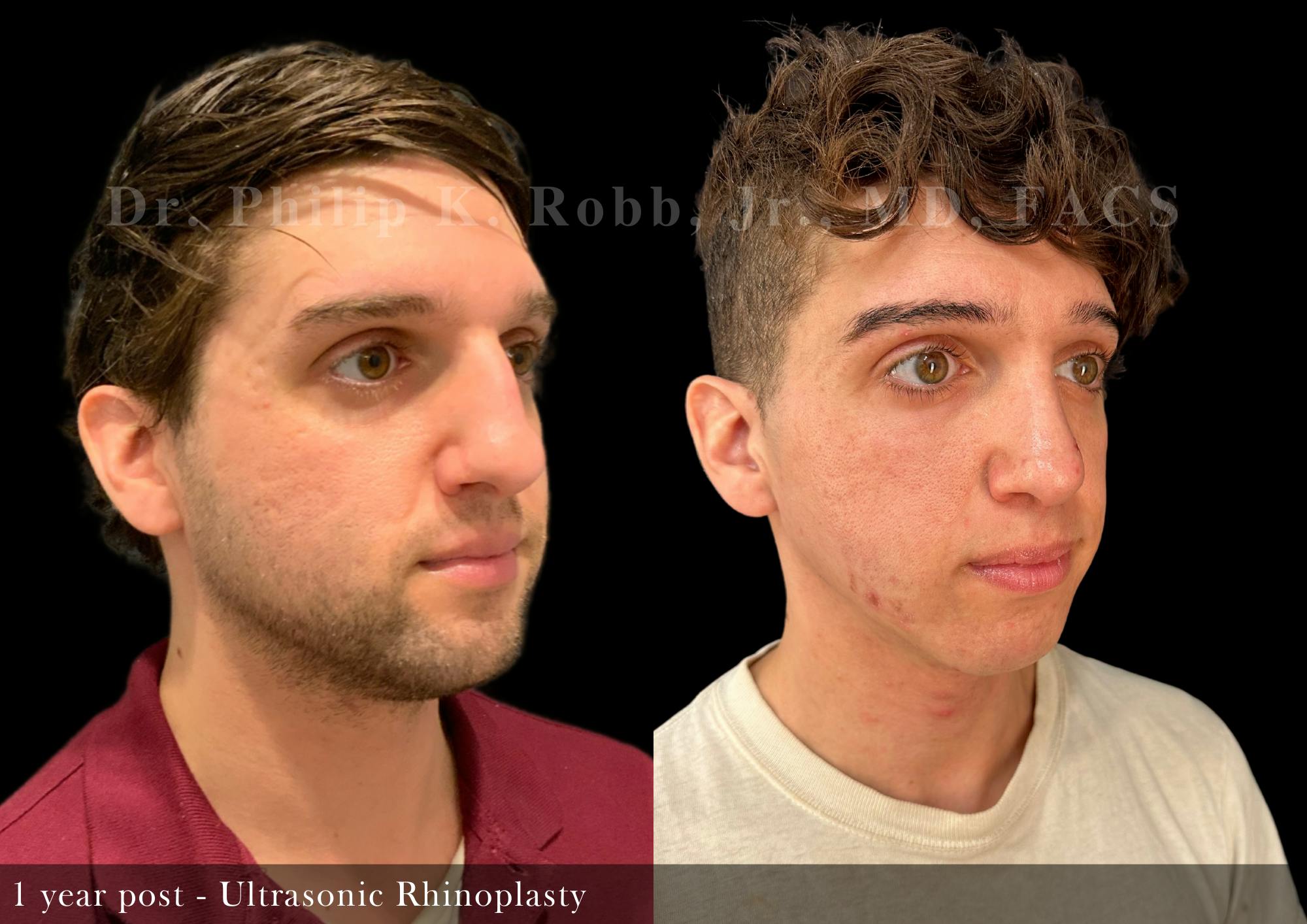 Ultrasonic Rhinoplasty Before & After Gallery - Patient 336768 - Image 2