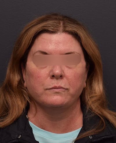 Facelift Before & After Gallery - Patient 428609 - Image 2