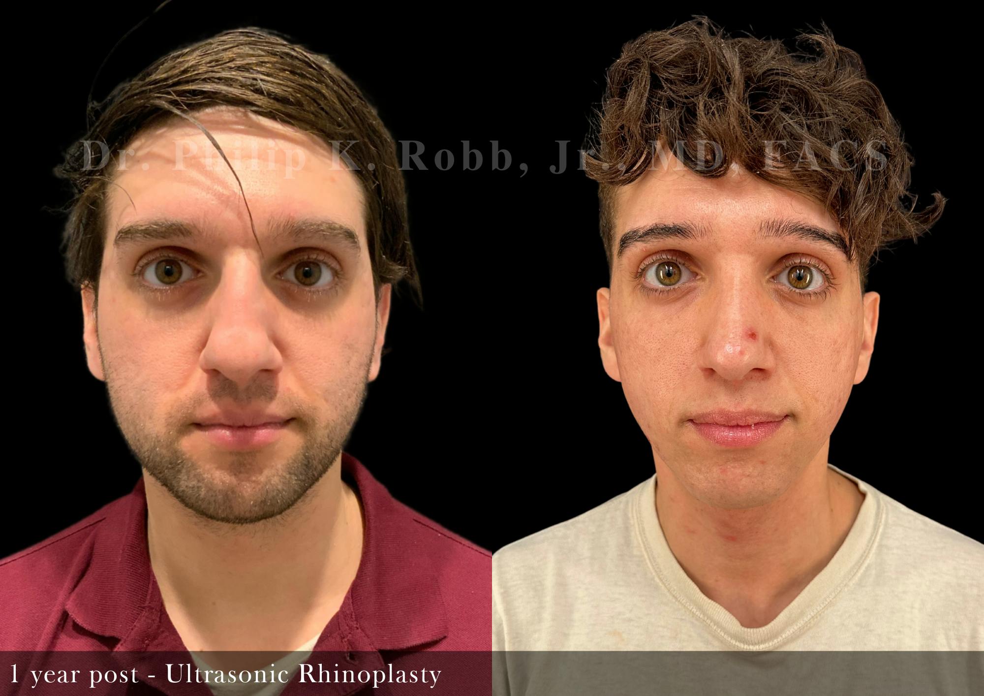 Ultrasonic Rhinoplasty Before & After Gallery - Patient 336768 - Image 3