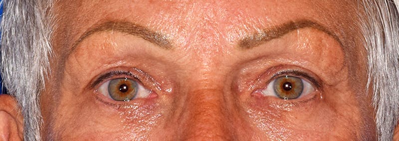 Upper Blepharoplasty Before & After Gallery - Patient 425364 - Image 2