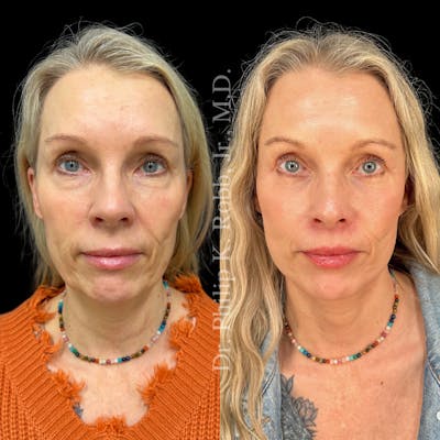 Lower Blepharoplasty Before & After Gallery - Patient 783981 - Image 1