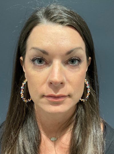 Laser Skin Resurfacing Before & After Gallery - Patient 201999 - Image 2