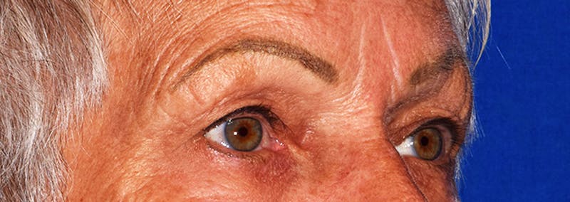 Upper Blepharoplasty Before & After Gallery - Patient 425364 - Image 3