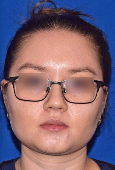 Buccal Fat Reduction Before & After Gallery - Patient 366277 - Image 2