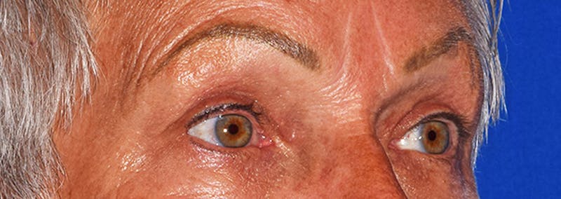 Upper Blepharoplasty Before & After Gallery - Patient 425364 - Image 4