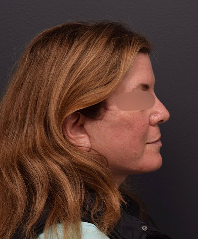 Facelift Before & After Gallery - Patient 428609 - Image 6