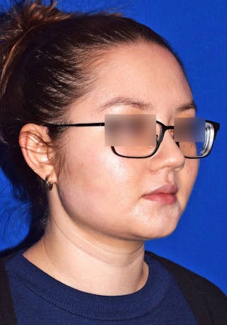 Buccal Fat Reduction Before & After Gallery - Patient 366277 - Image 4