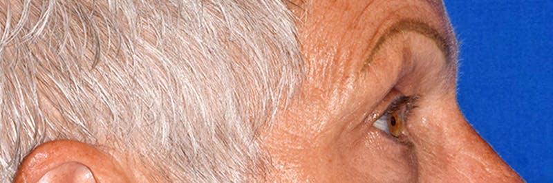 Upper Blepharoplasty Before & After Gallery - Patient 425364 - Image 5