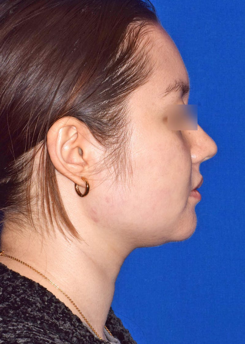 Buccal Fat Reduction Before & After Gallery - Patient 366277 - Image 5
