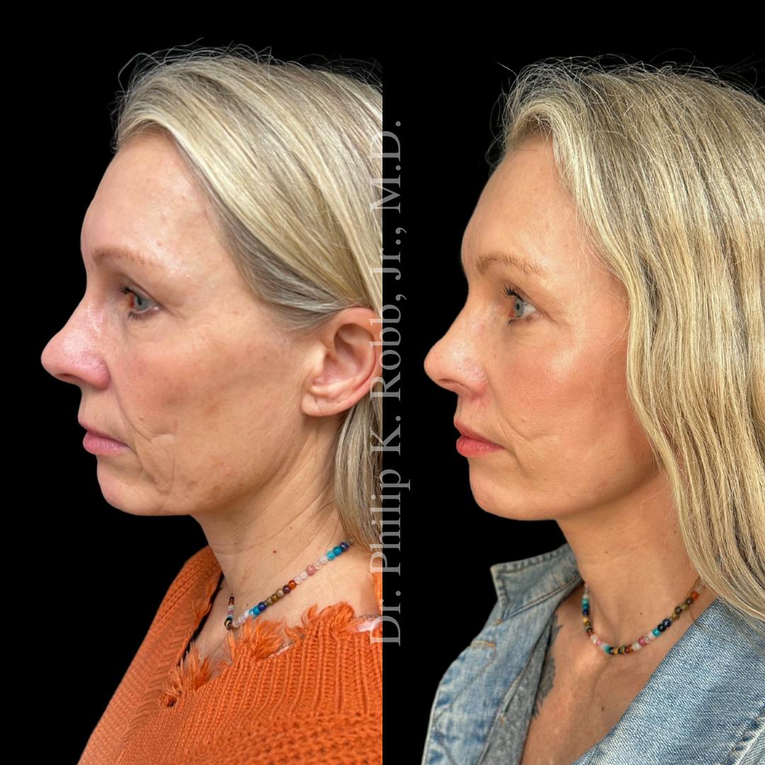 Lower Blepharoplasty Before & After Gallery - Patient 783981 - Image 4