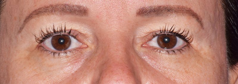 Upper Blepharoplasty Before & After Gallery - Patient 373907 - Image 1