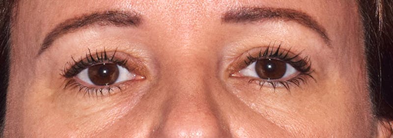 Upper Blepharoplasty Before & After Gallery - Patient 373907 - Image 2