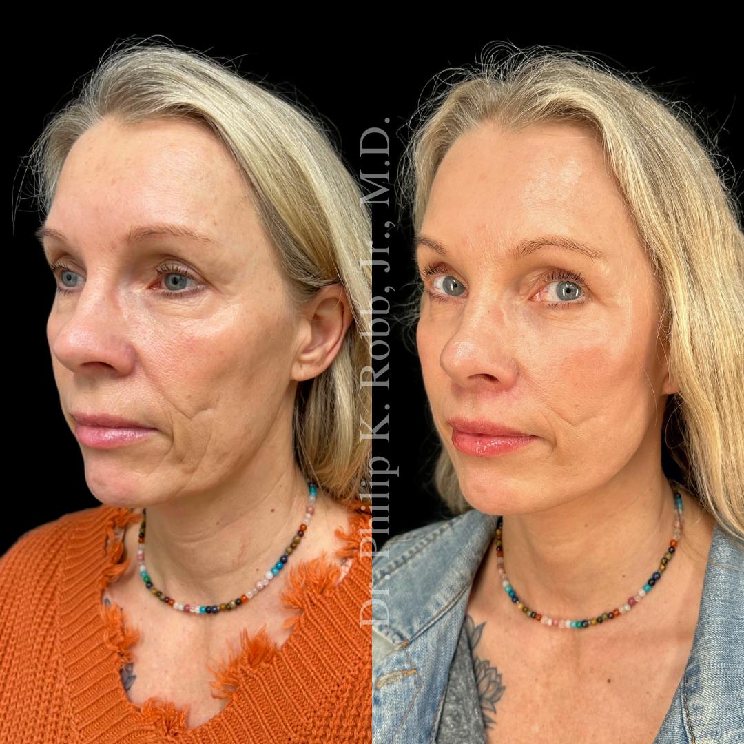 Lower Blepharoplasty Before & After Gallery - Patient 783981 - Image 5