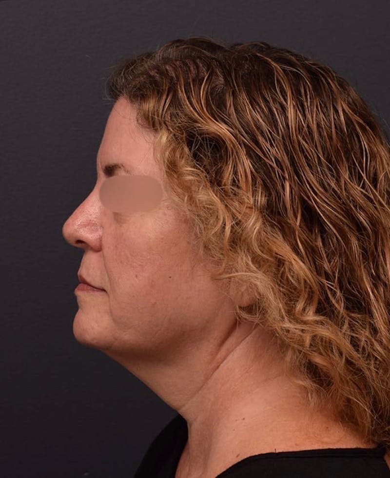 Facelift Before & After Gallery - Patient 428609 - Image 9