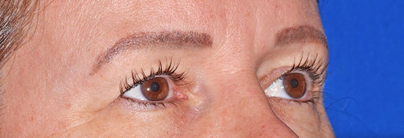 Upper Blepharoplasty Before & After Gallery - Patient 373907 - Image 3