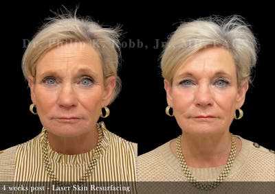 Laser Skin Resurfacing Before & After Gallery - Patient 110433 - Image 1