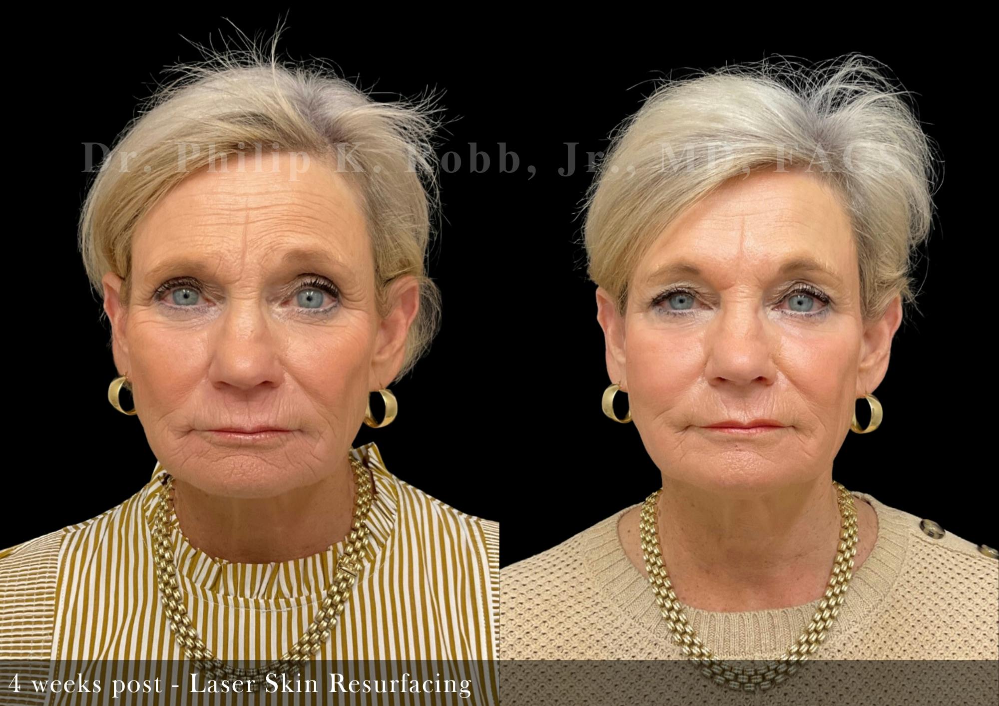 Laser Skin Resurfacing Before & After Gallery - Patient 110433 - Image 1