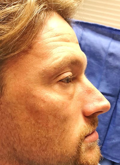 Lower Blepharoplasty Before & After Gallery - Patient 163385 - Image 1