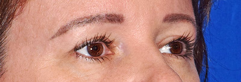 Upper Blepharoplasty Before & After Gallery - Patient 373907 - Image 4