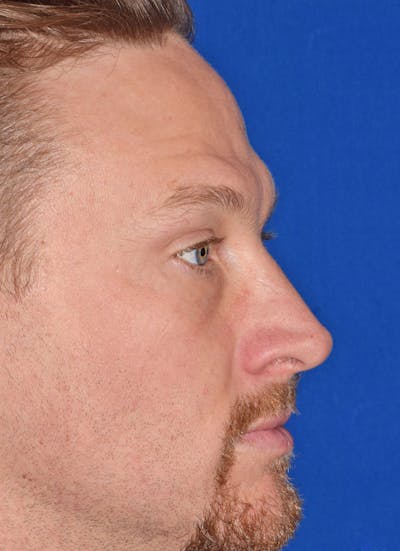 Lower Blepharoplasty Before & After Gallery - Patient 163385 - Image 2
