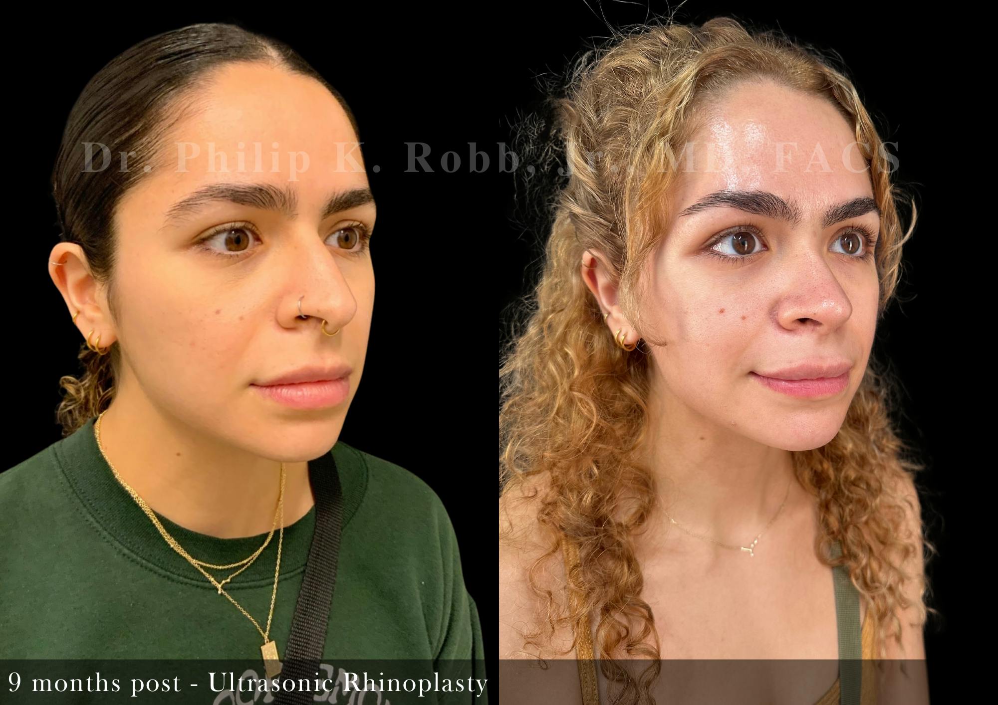 Ultrasonic Rhinoplasty Before & After Gallery - Patient 344168 - Image 2