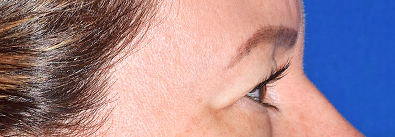 Upper Blepharoplasty Before & After Gallery - Patient 373907 - Image 5