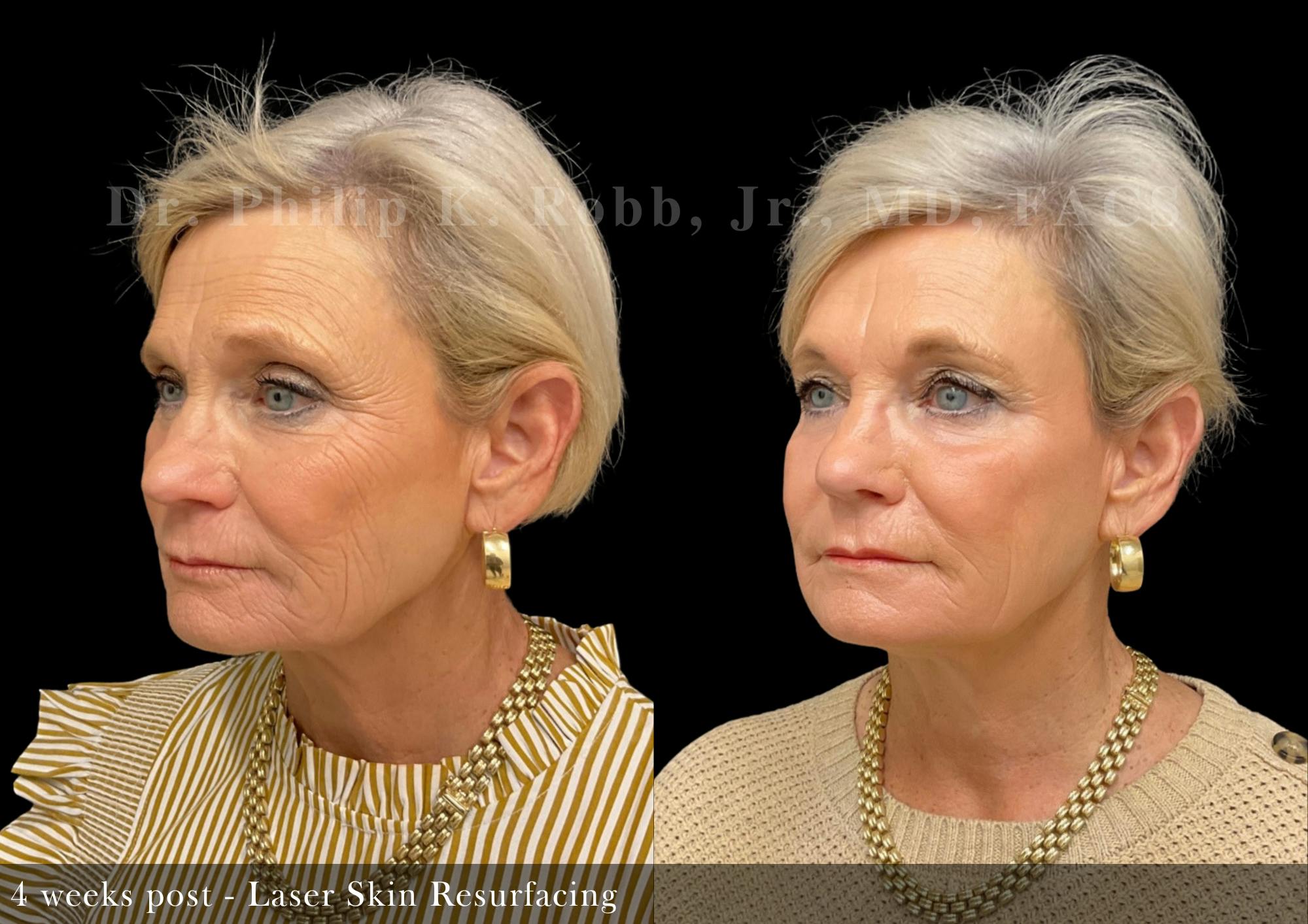 Laser Skin Resurfacing Before & After Gallery - Patient 110433 - Image 2