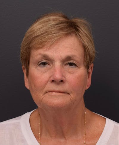 Facelift Before & After Gallery - Patient 150912 - Image 1