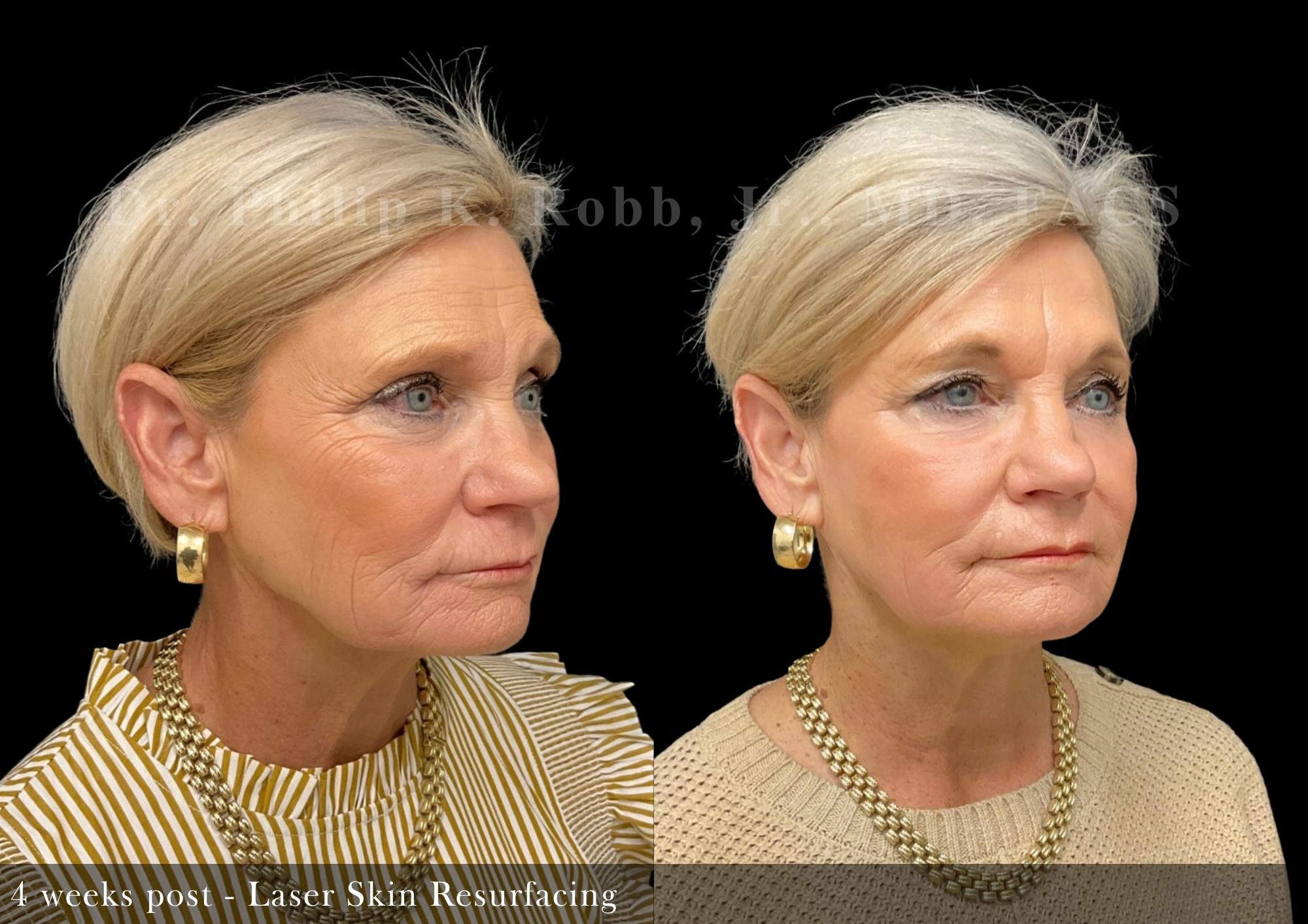 Laser Skin Resurfacing Before & After Gallery - Patient 110433 - Image 3