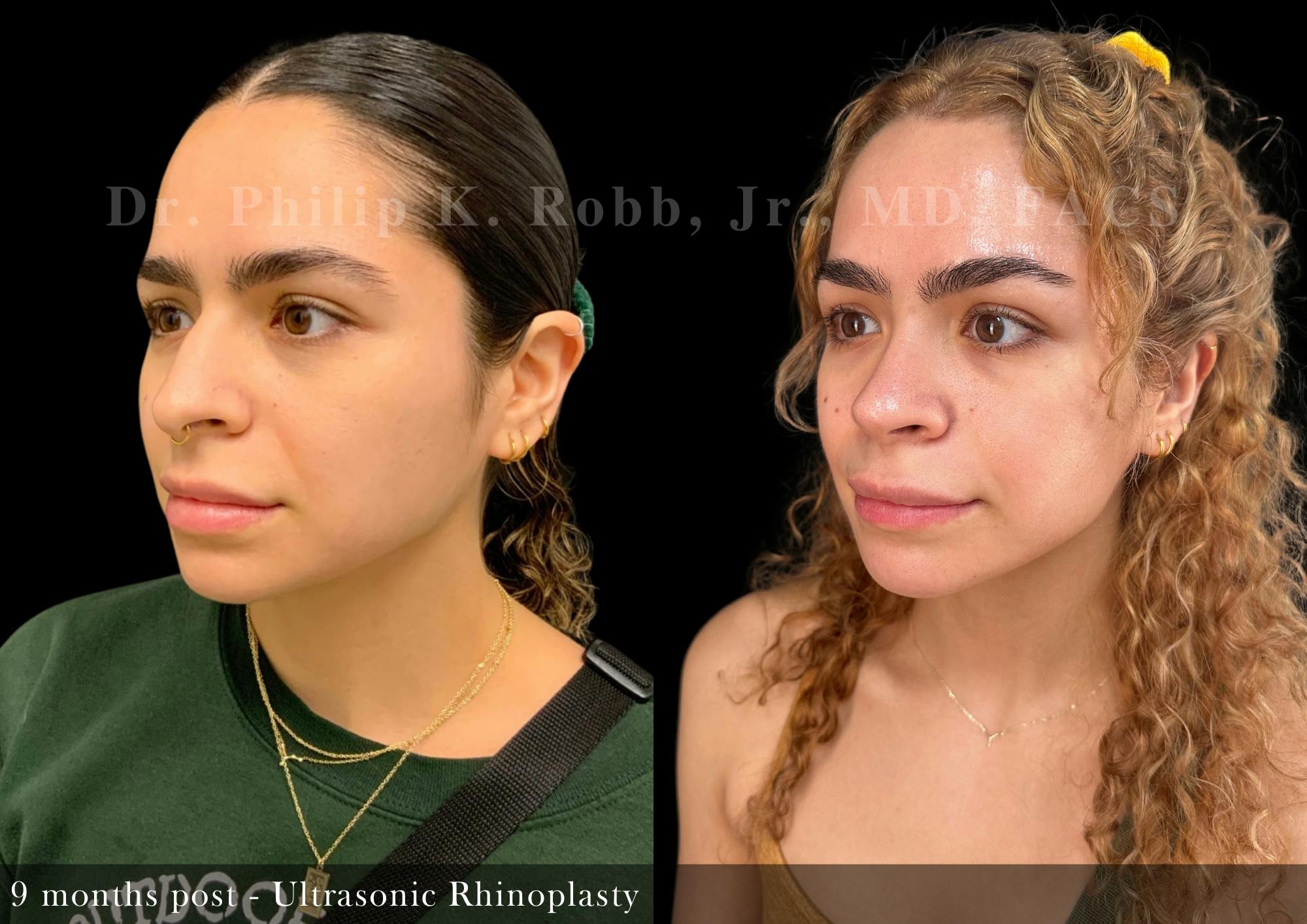 Ultrasonic Rhinoplasty Before & After Gallery - Patient 344168 - Image 4
