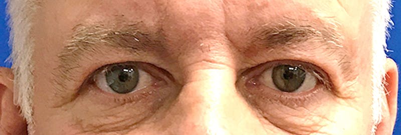 Upper Blepharoplasty Before & After Gallery - Patient 197125 - Image 1