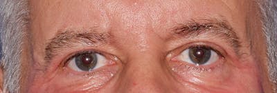 Upper Blepharoplasty Before & After Gallery - Patient 197125 - Image 2