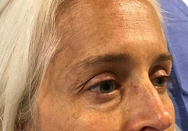 Lower Blepharoplasty Before & After Gallery - Patient 671555 - Image 1