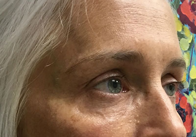 Lower Blepharoplasty Before & After Gallery - Patient 671555 - Image 2