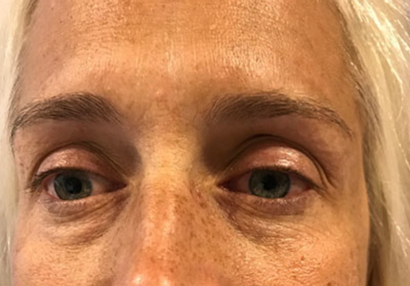 Lower Blepharoplasty Before & After Gallery - Patient 671555 - Image 3