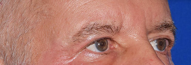 Upper Blepharoplasty Before & After Gallery - Patient 197125 - Image 4