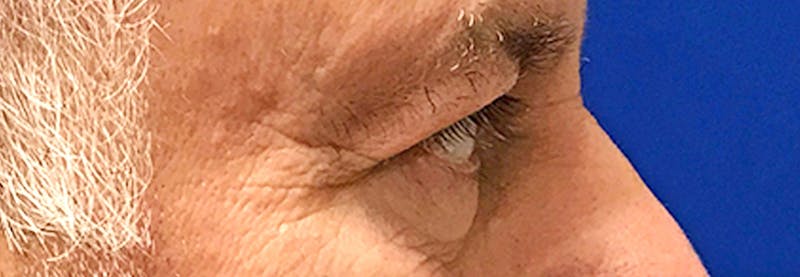 Upper Blepharoplasty Before & After Gallery - Patient 197125 - Image 5