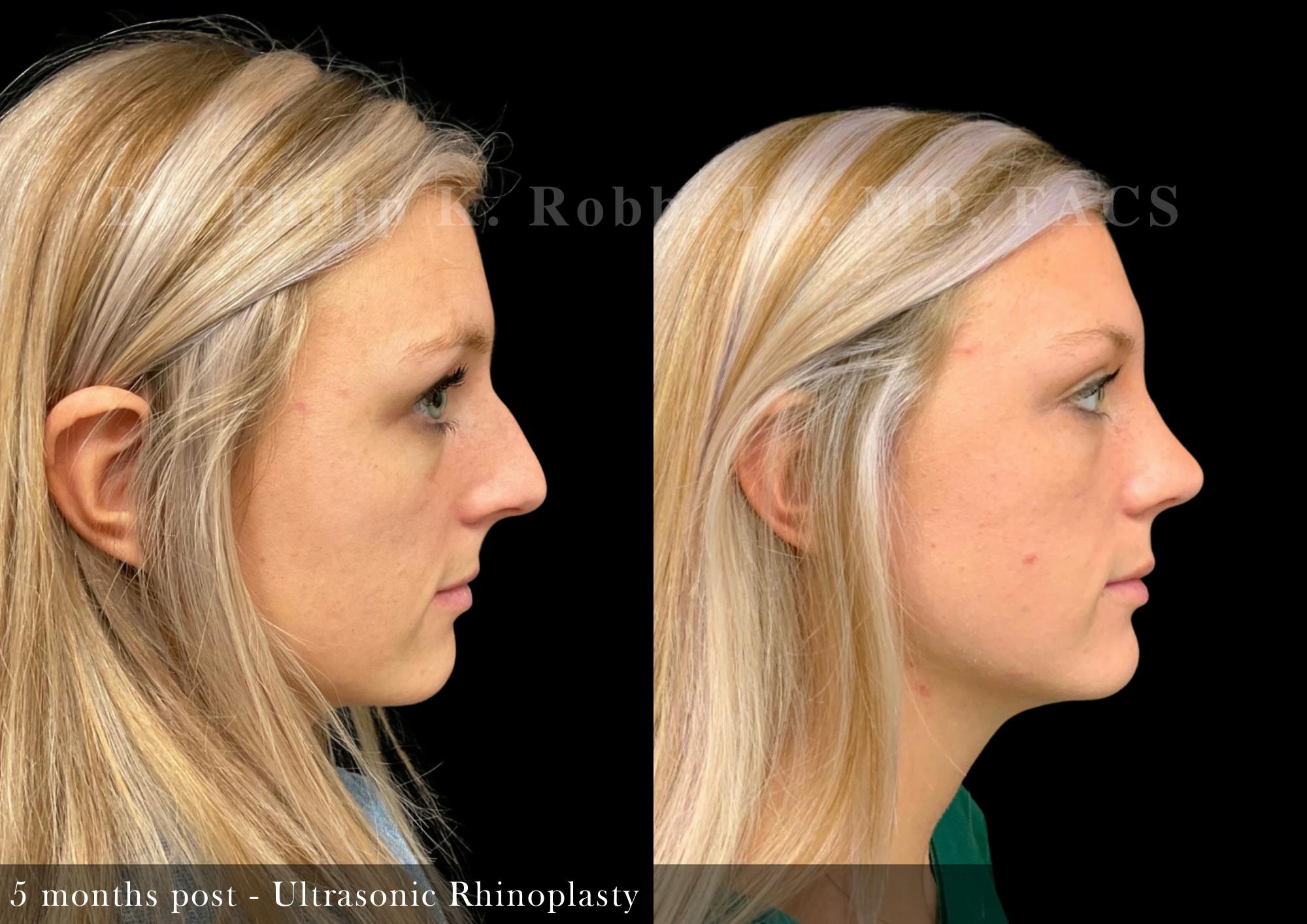Ultrasonic Rhinoplasty Before & After Gallery - Patient 441686 - Image 1