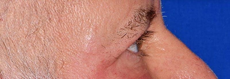 Upper Blepharoplasty Before & After Gallery - Patient 197125 - Image 6