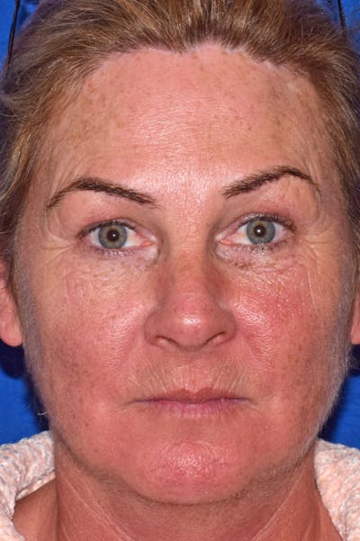 Upper Blepharoplasty Before & After Gallery - Patient 808697 - Image 1