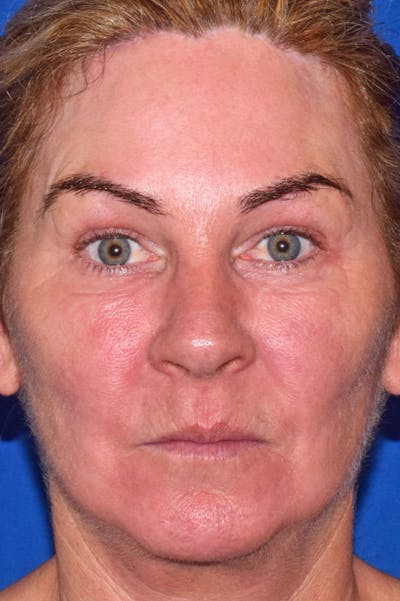 Upper Blepharoplasty Before & After Gallery - Patient 808697 - Image 2