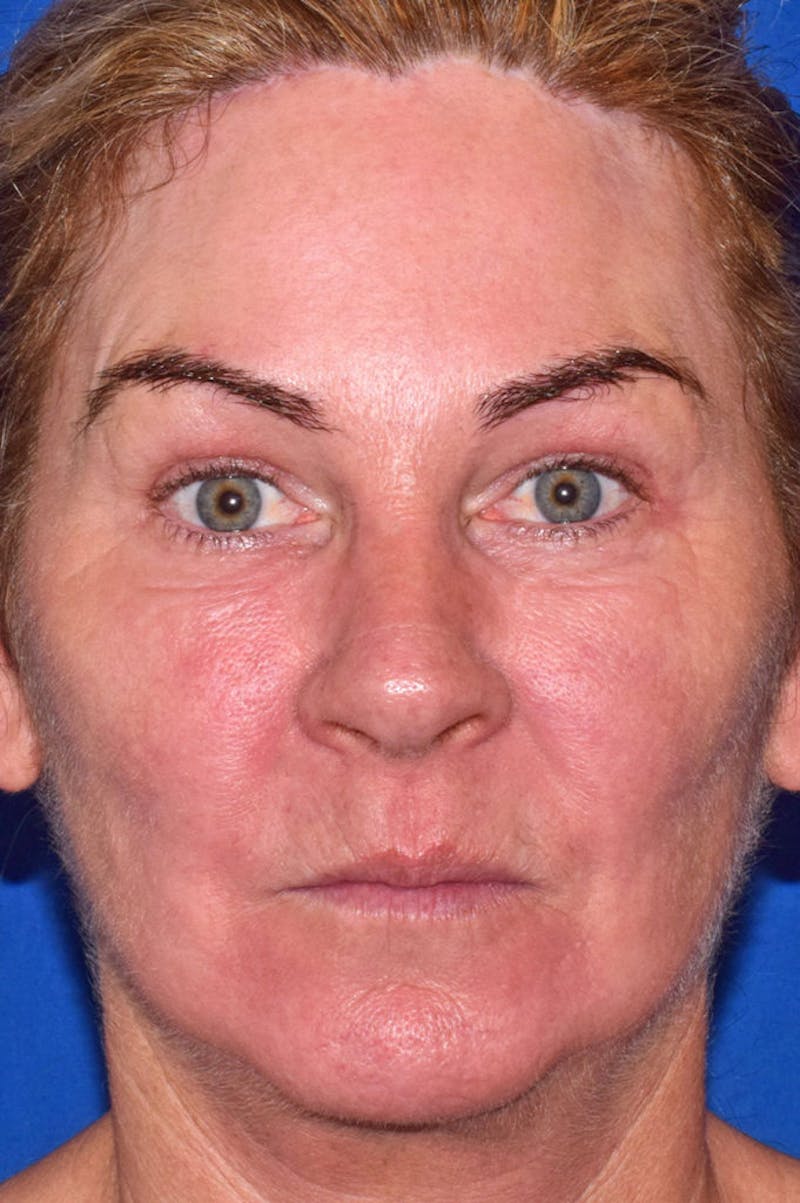 Upper Blepharoplasty Before & After Gallery - Patient 808697 - Image 2