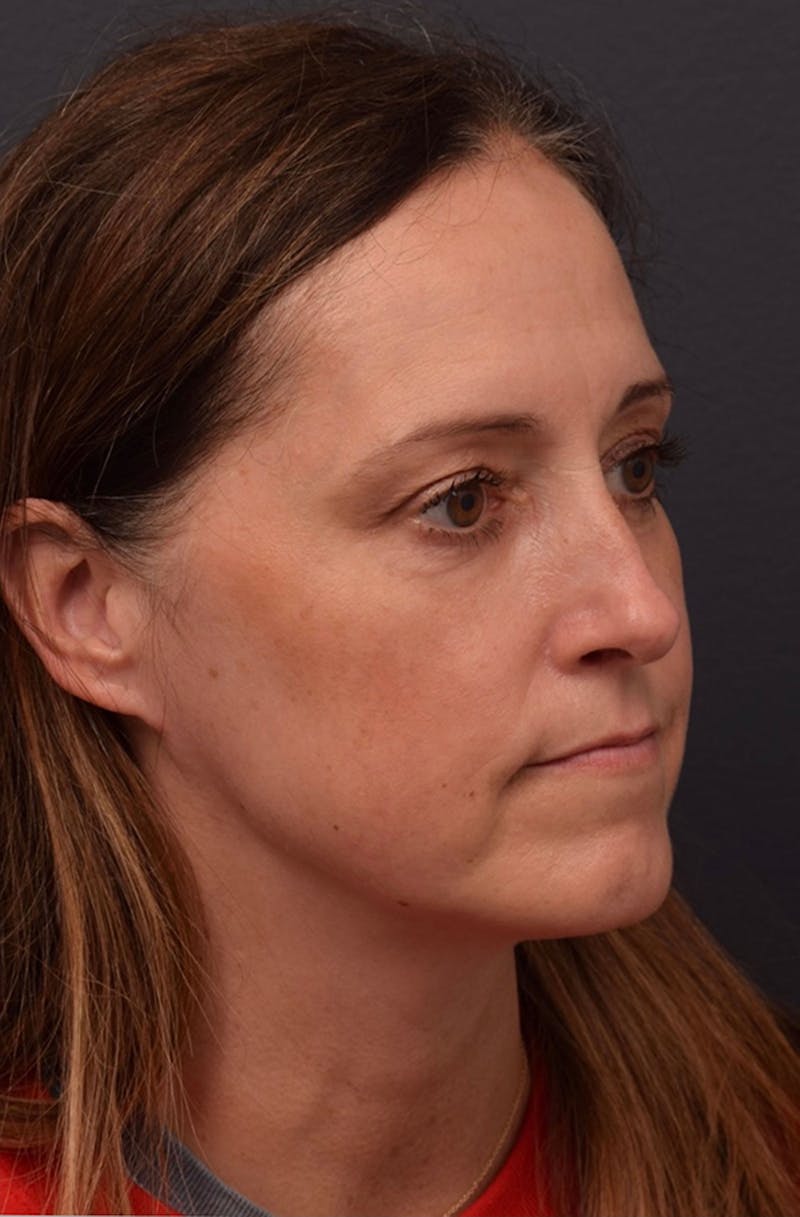 Laser Skin Resurfacing Before & After Gallery - Patient 187754 - Image 4
