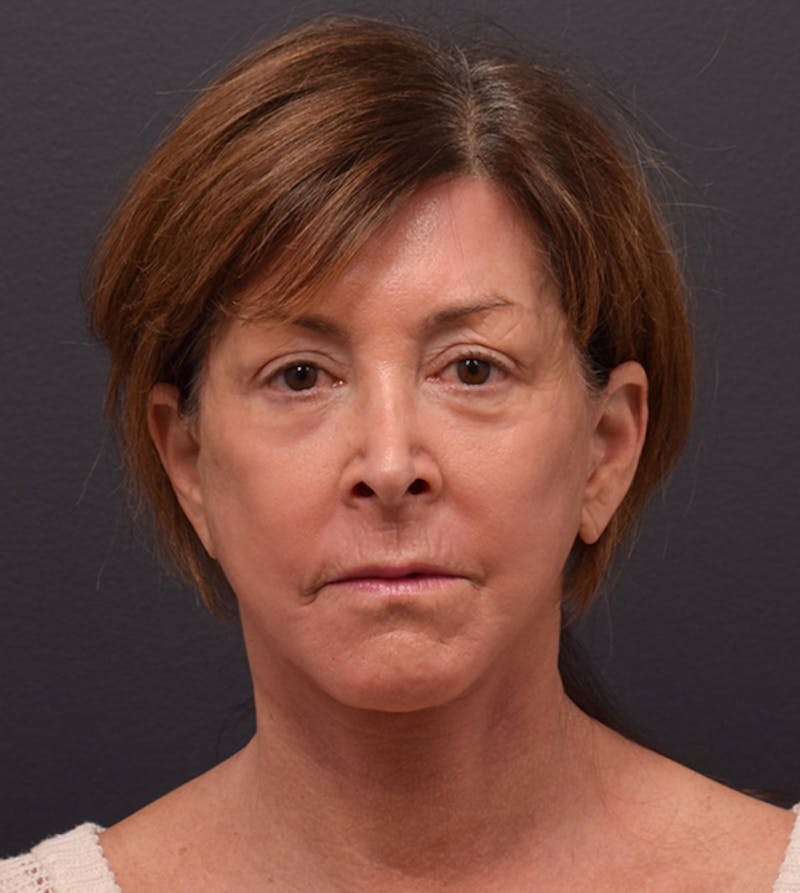 Facelift Before & After Gallery - Patient 354273 - Image 2