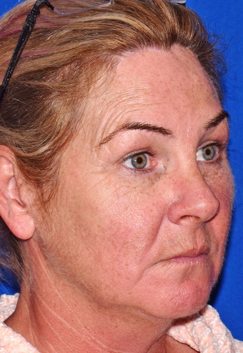 Upper Blepharoplasty Before & After Gallery - Patient 808697 - Image 3