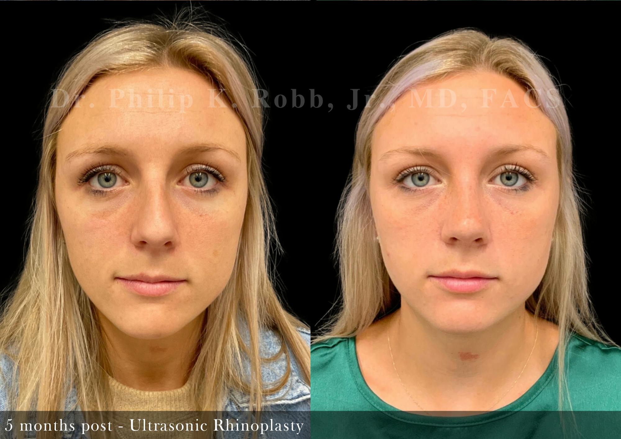 Ultrasonic Rhinoplasty Before & After Gallery - Patient 441686 - Image 3