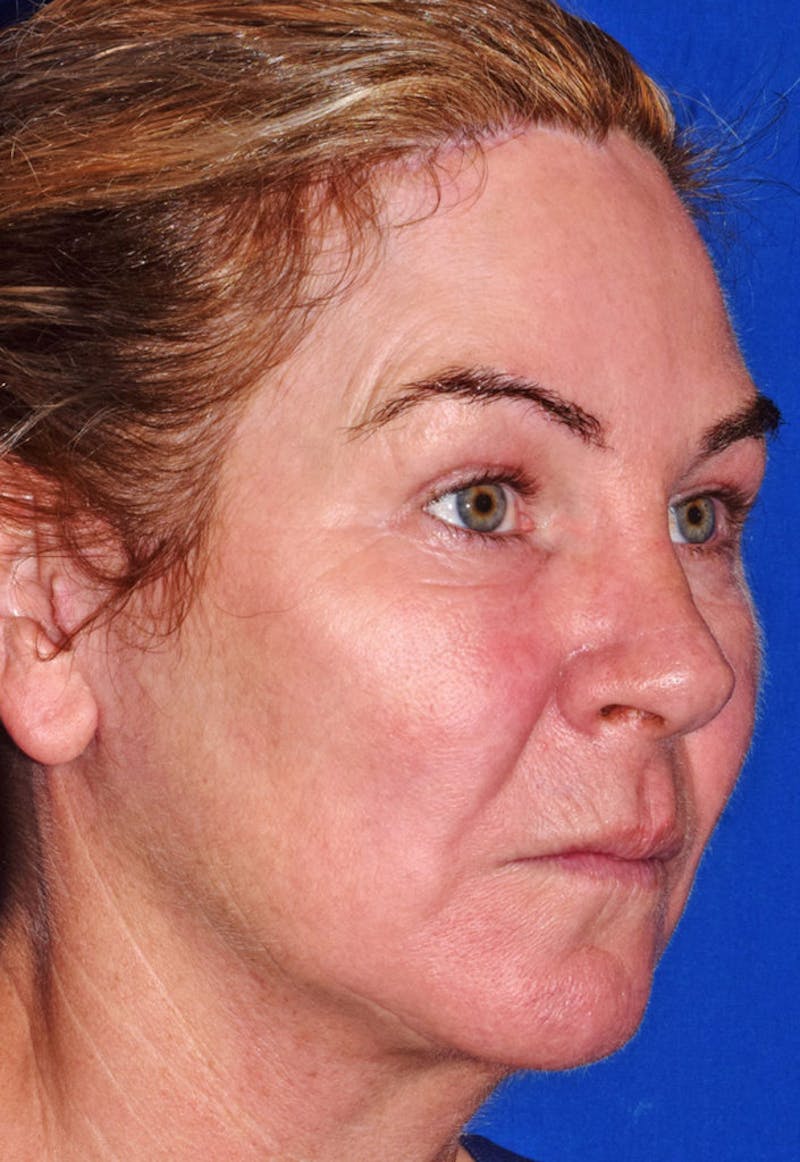 Upper Blepharoplasty Before & After Gallery - Patient 808697 - Image 4